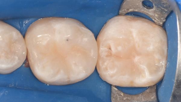 Лечение кариеса зубов 4.5, 4.6, 4.7